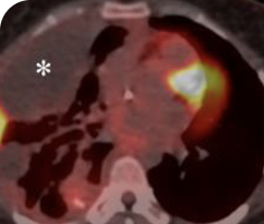 Initial diagnosis scans of patient with bone metastases Initial diagnosis scan of 30-year-old female patient with bone metastases