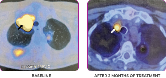 Metastatic papillary thyroid cancer female patient scan in primary and metastatic lesions Scan of primary and metastatic lesions from a Metastatic disease for a 56-year-old female patient