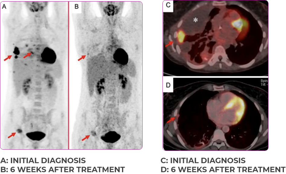 Metastatic NSCLC patient lung and bone scan 2 in primary and metastatic lesions Scan of lungs and bones in primary and metastatic lesions from a Metastatic NSCLC for a 30-year-old female patient