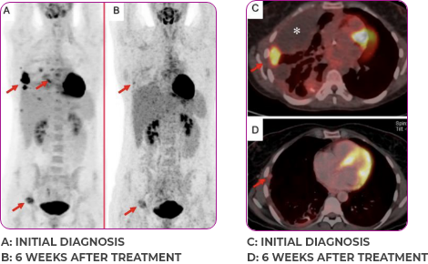 Metastatic NSCLC patient lung and bone scan 2 in primary and metastatic lesions Scan of lungs and bones in primary and metastatic lesions from a Metastatic NSCLC for a 30-year-old female patient