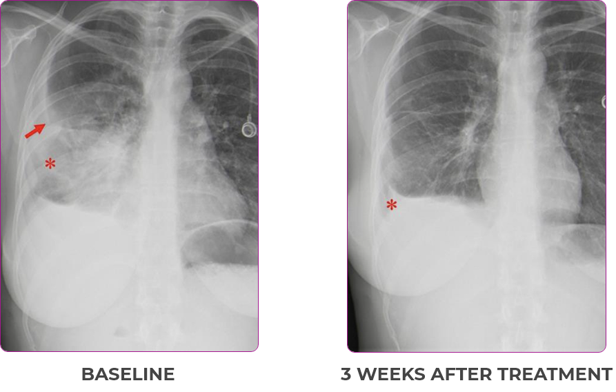 Metastatic NSCLC patient lung scan 1 in primary and metastatic lesions Scan of primary and metastatic lesions from a Metastatic NSCLC for a 30-year-old female patient