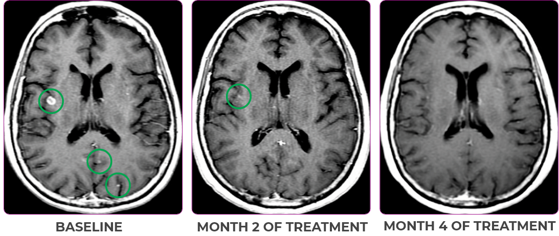 Brain metastases scan in primary and metastatic lesions Brain scan in primary and metastatic lesions for a 76-year-old female patient