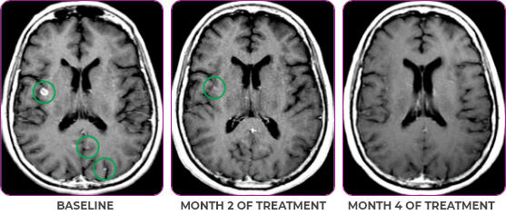 Brain metastases scan in primary and metastatic lesions Brain scan in primary and metastatic lesions for a 76-year-old female patient