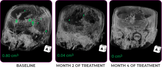 Brain metastases scan showing primary and metastatic lesions with measurements in green Brain metastases scan showing measurements in green for primary and metastatic lesions in a 76-year-old female patient.