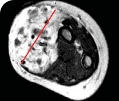 Baseline scan for pediatric patient with infantile fibrosarcoma Baseline tumor scan for a 5-year-old patient with infantile fibrosarcoma.