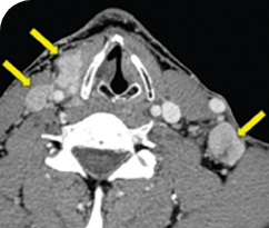 Baseline scan for male patient with thyroid cancer Baseline scan for a 33-year-old male patient with thyroid cancer
