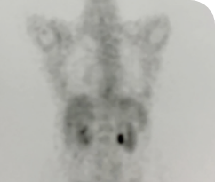 Post treatment body scan of thyroid cancer patient with multiple metastases Post treatment body scan for a 56-year-old female patient with thyroid cancer who has multiple metastases.